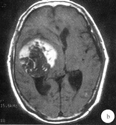 【病例】颅底脂肪母细胞瘤1例CT及MR影像表现分析 【病例】颅底脂肪母细胞瘤1例CT及MR影像表现分析