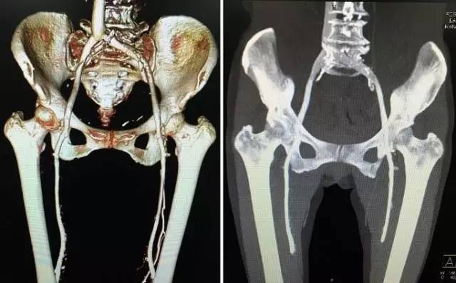 下肢动静脉CTA解剖和10种常见疾病 下肢动静脉CTA解剖和10种常见疾病