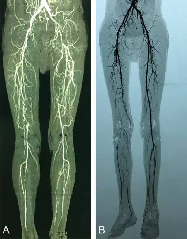 下肢动静脉CTA解剖和10种常见疾病 下肢动静脉CTA解剖和10种常见疾病