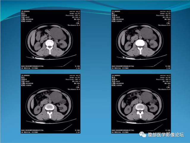 【病例】腹膜后高分化脂肪肉瘤1例CT 【病例】腹膜后高分化脂肪肉瘤1例CT