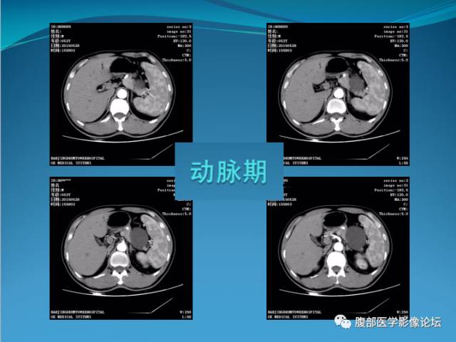 【病例】腹膜后高分化脂肪肉瘤1例CT 【病例】腹膜后高分化脂肪肉瘤1例CT
