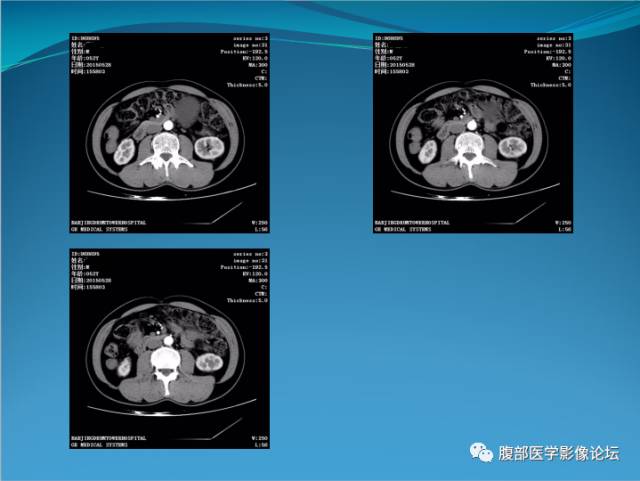 【病例】腹膜后高分化脂肪肉瘤1例CT 【病例】腹膜后高分化脂肪肉瘤1例CT