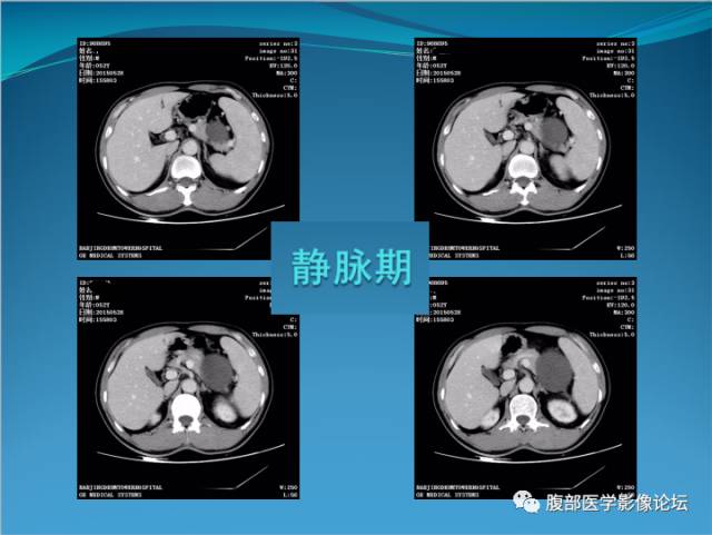 【病例】腹膜后高分化脂肪肉瘤1例CT 【病例】腹膜后高分化脂肪肉瘤1例CT