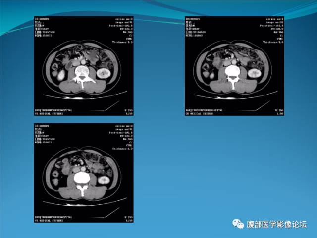 【病例】腹膜后高分化脂肪肉瘤1例CT 【病例】腹膜后高分化脂肪肉瘤1例CT