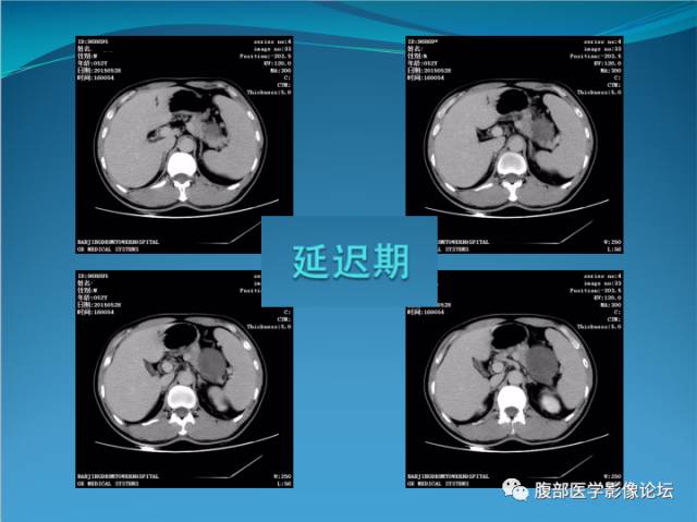 【病例】腹膜后高分化脂肪肉瘤1例CT 【病例】腹膜后高分化脂肪肉瘤1例CT