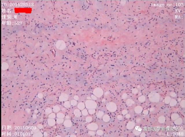 【病例】腹膜后高分化脂肪肉瘤1例CT 【病例】腹膜后高分化脂肪肉瘤1例CT