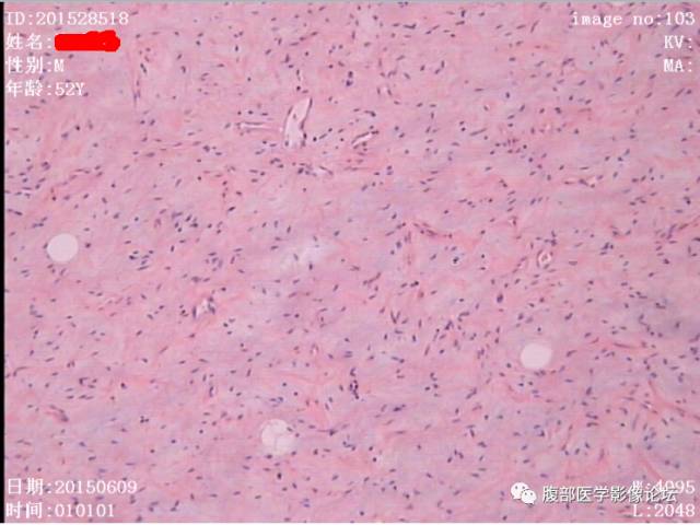 【病例】腹膜后高分化脂肪肉瘤1例CT 【病例】腹膜后高分化脂肪肉瘤1例CT
