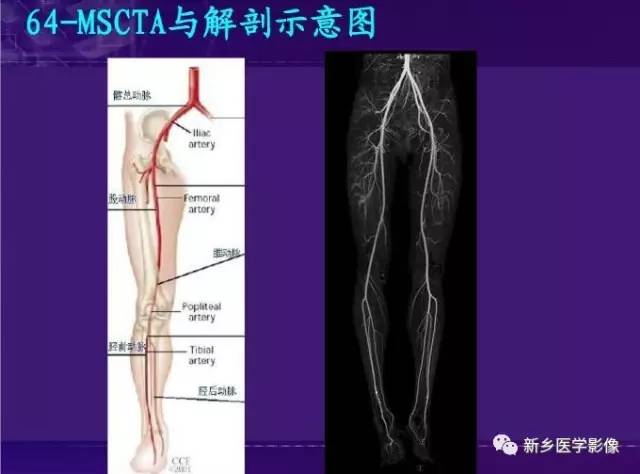 【PPT】64-MSCTA 在下肢动脉硬化闭塞症诊断中的作用