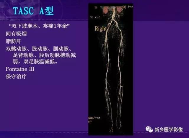 【PPT】64-MSCTA 在下肢动脉硬化闭塞症诊断中的作用