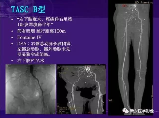 【PPT】64-MSCTA 在下肢动脉硬化闭塞症诊断中的作用