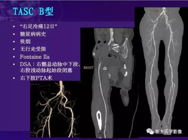 【PPT】64-MSCTA 在下肢动脉硬化闭塞症诊断中的作用