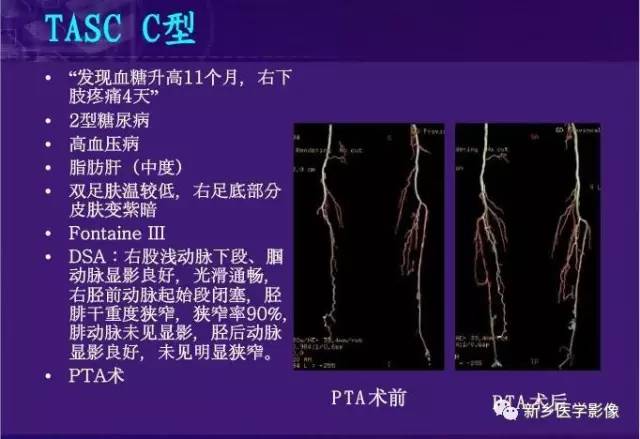 【PPT】64-MSCTA 在下肢动脉硬化闭塞症诊断中的作用