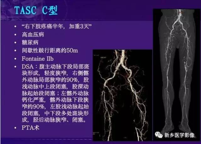 【PPT】64-MSCTA 在下肢动脉硬化闭塞症诊断中的作用