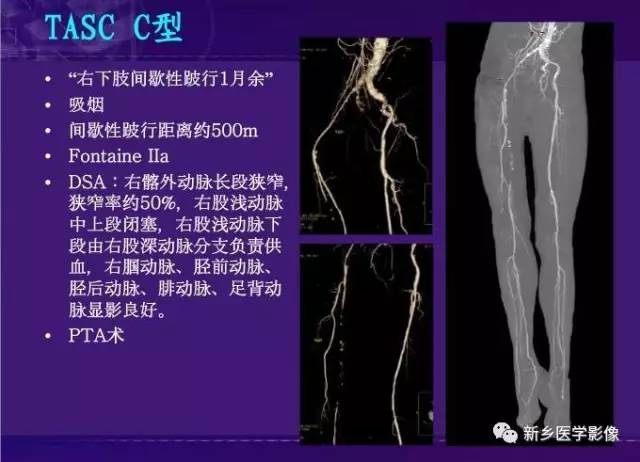 【PPT】64-MSCTA 在下肢动脉硬化闭塞症诊断中的作用