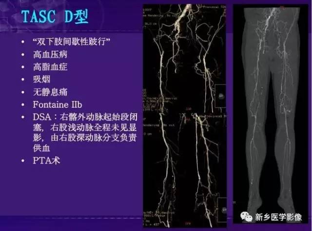 【PPT】64-MSCTA 在下肢动脉硬化闭塞症诊断中的作用
