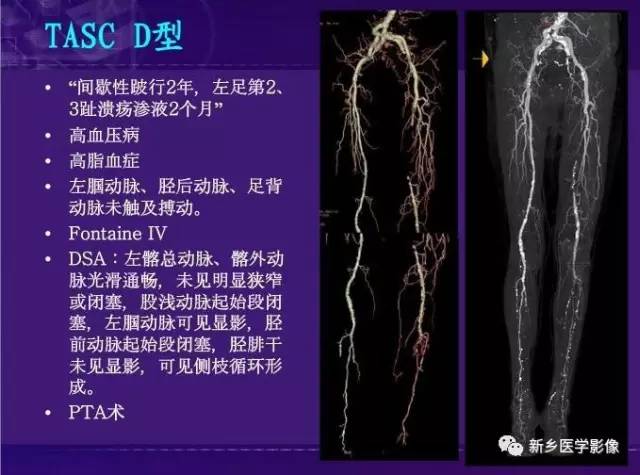 【PPT】64-MSCTA 在下肢动脉硬化闭塞症诊断中的作用