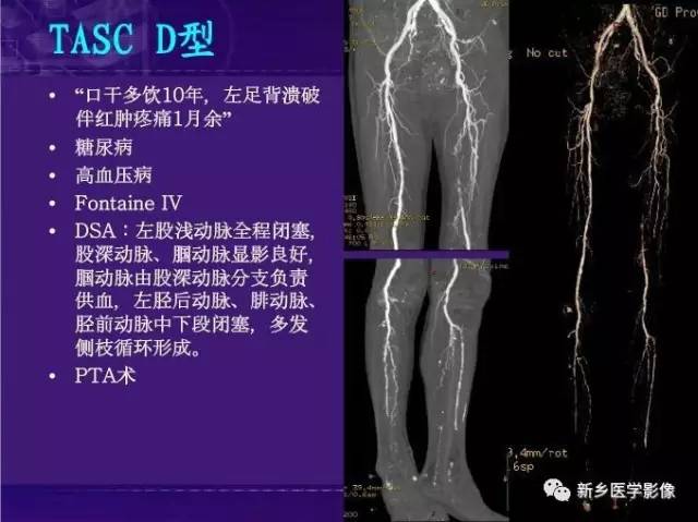 【PPT】64-MSCTA 在下肢动脉硬化闭塞症诊断中的作用