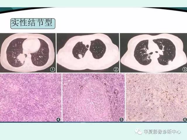 【病例】IgG4相关性肺疾病1例CT影像表现 【病例】IgG4相关性肺疾病1例CT影像表现