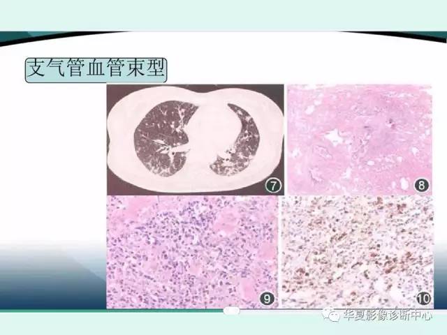 【病例】IgG4相关性肺疾病1例CT影像表现 【病例】IgG4相关性肺疾病1例CT影像表现