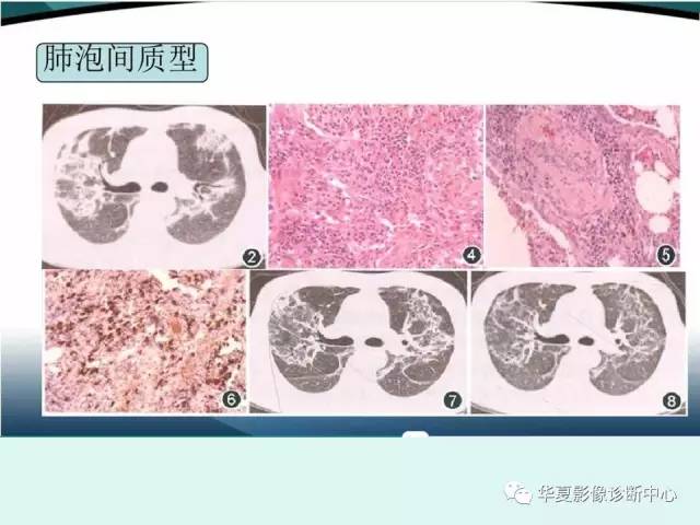 【病例】IgG4相关性肺疾病1例CT影像表现 【病例】IgG4相关性肺疾病1例CT影像表现