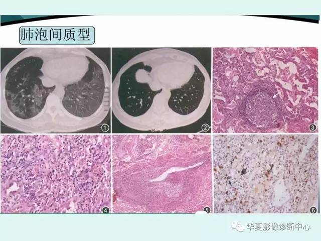 【病例】IgG4相关性肺疾病1例CT影像表现 【病例】IgG4相关性肺疾病1例CT影像表现