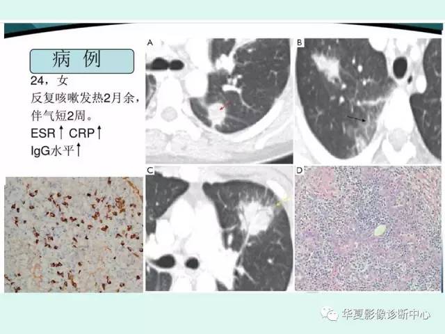 【病例】IgG4相关性肺疾病1例CT影像表现 【病例】IgG4相关性肺疾病1例CT影像表现