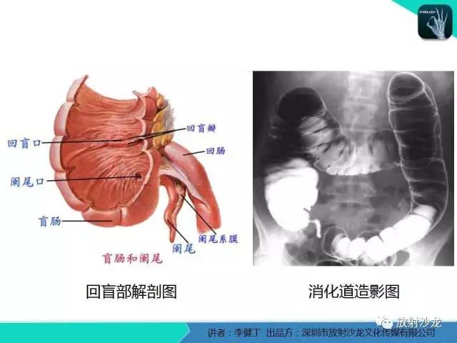 【PPT】回盲部常见病变的MSCT表现