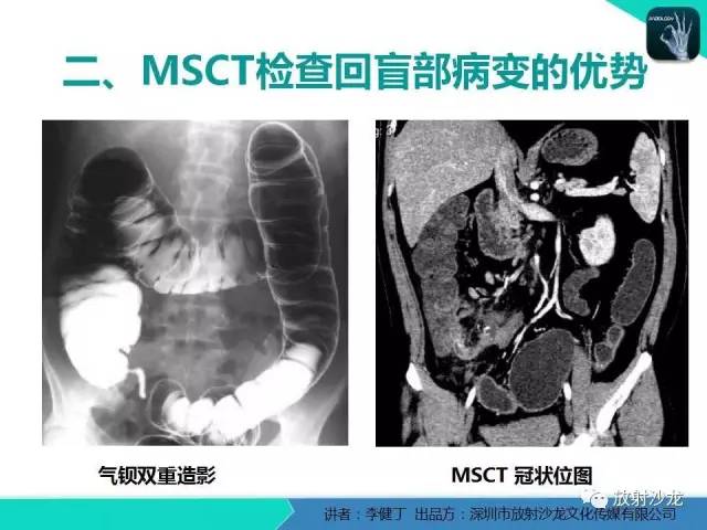 【PPT】回盲部常见病变的MSCT表现
