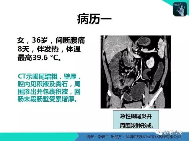 【PPT】回盲部常见病变的MSCT表现