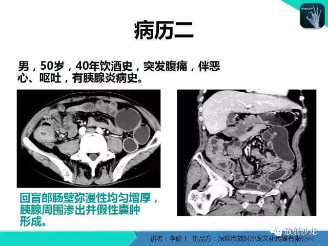 【PPT】回盲部常见病变的MSCT表现