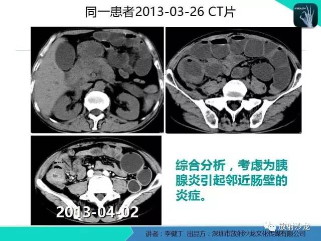 【PPT】回盲部常见病变的MSCT表现