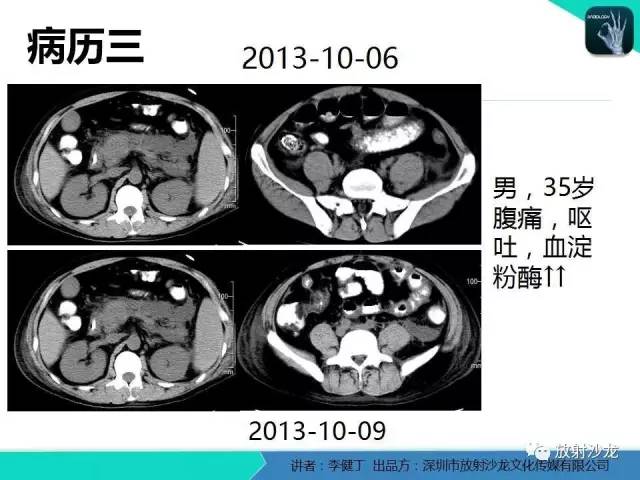 【PPT】回盲部常见病变的MSCT表现