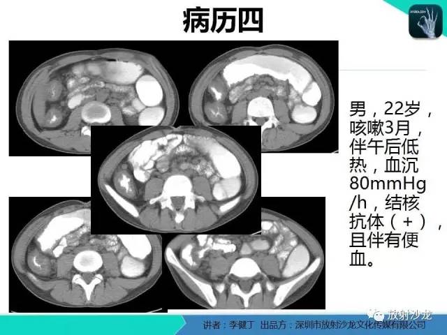 【PPT】回盲部常见病变的MSCT表现