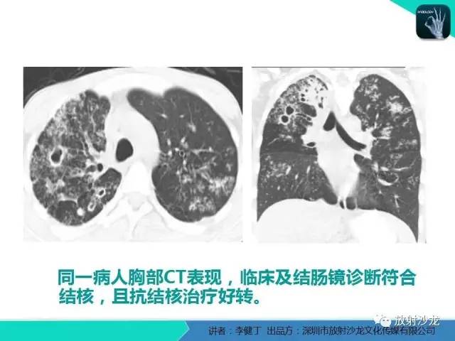 【PPT】回盲部常见病变的MSCT表现