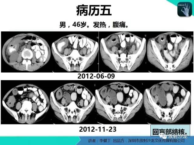 【PPT】回盲部常见病变的MSCT表现