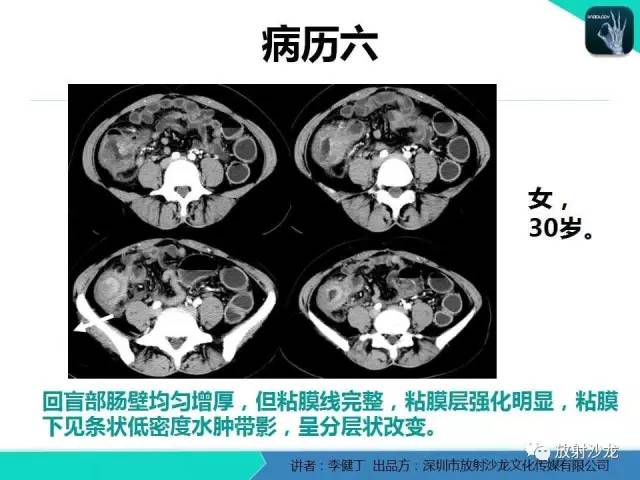 【PPT】回盲部常见病变的MSCT表现