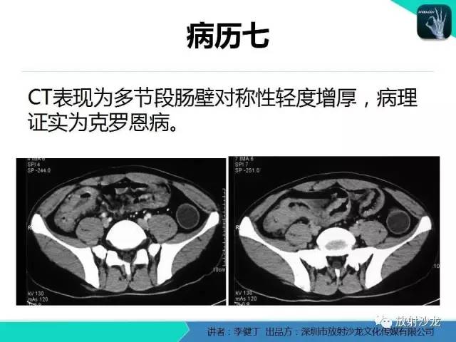 【PPT】回盲部常见病变的MSCT表现