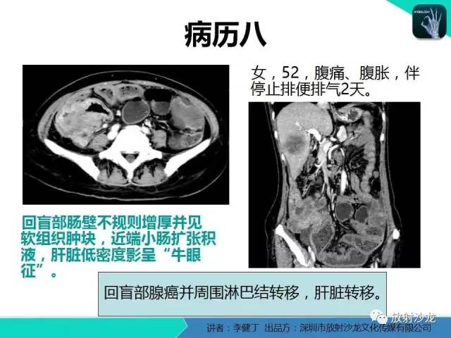 【PPT】回盲部常见病变的MSCT表现