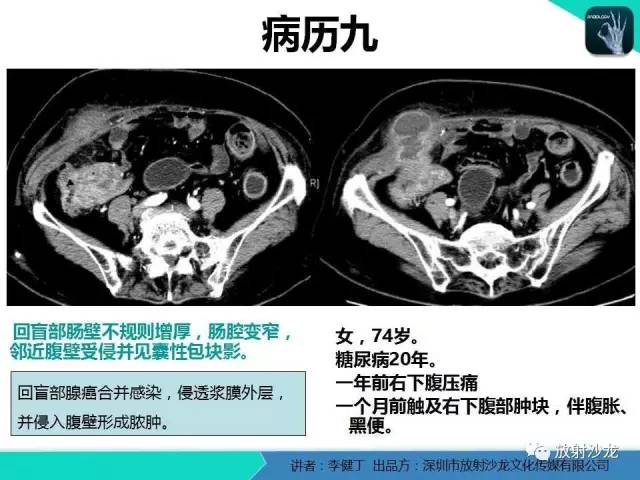 【PPT】回盲部常见病变的MSCT表现