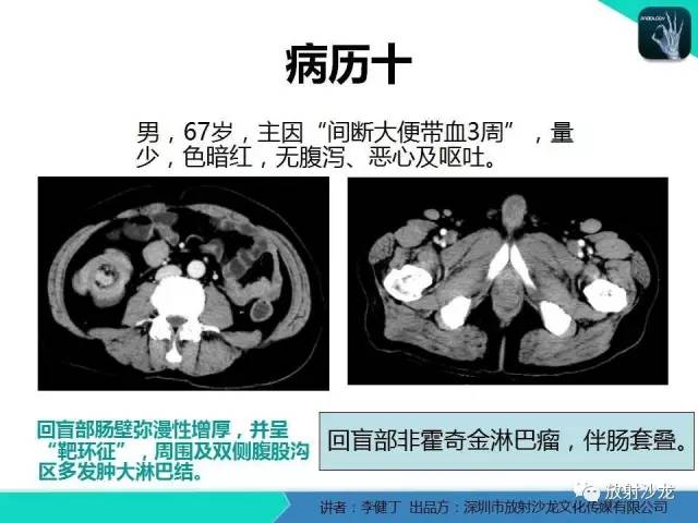 【PPT】回盲部常见病变的MSCT表现