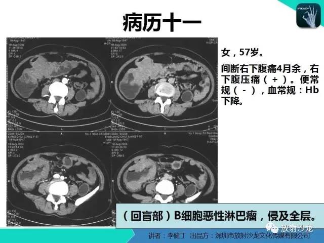 【PPT】回盲部常见病变的MSCT表现