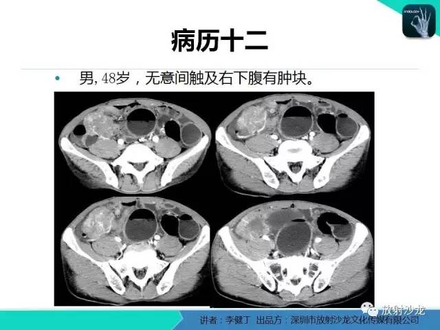 【PPT】回盲部常见病变的MSCT表现
