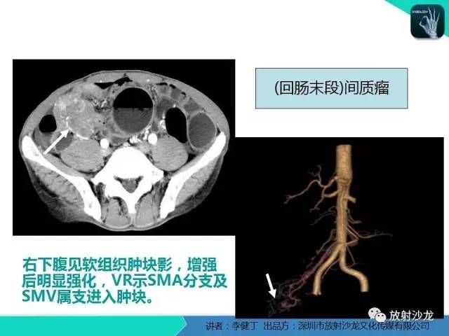 【PPT】回盲部常见病变的MSCT表现
