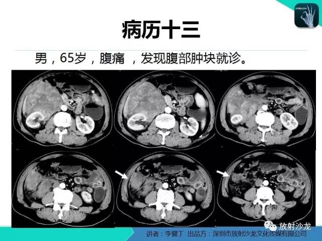 【PPT】回盲部常见病变的MSCT表现