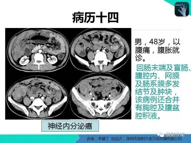 【PPT】回盲部常见病变的MSCT表现