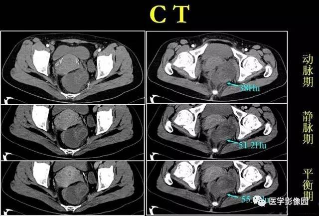 【病例】侵袭性血管黏液瘤1例CT 【病例】侵袭性血管黏液瘤1例CT