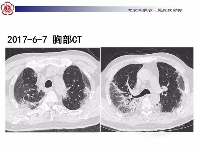 【病例】特发性间质性肺炎2例CT影像表现