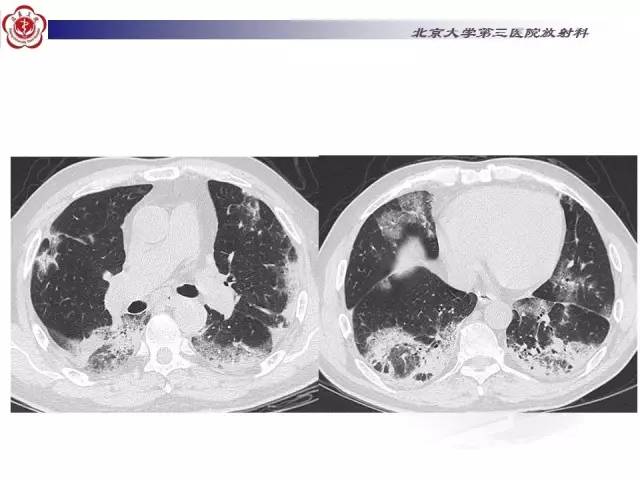 【病例】特发性间质性肺炎2例CT影像表现