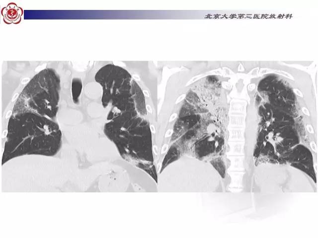 【病例】特发性间质性肺炎2例CT影像表现