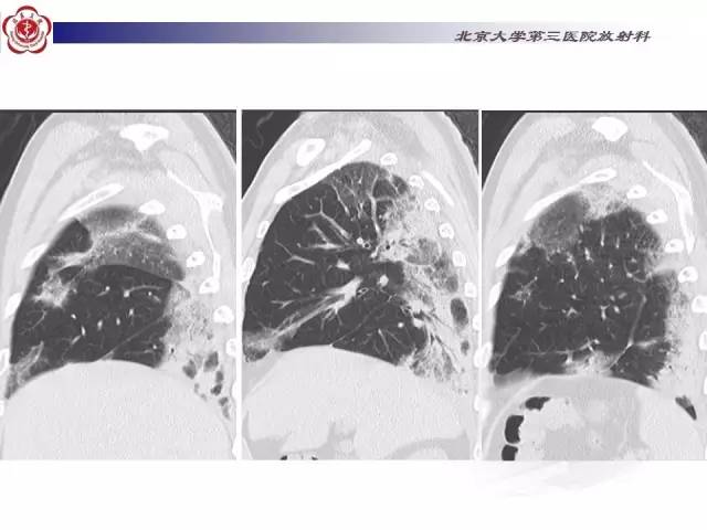 【病例】特发性间质性肺炎2例CT影像表现
